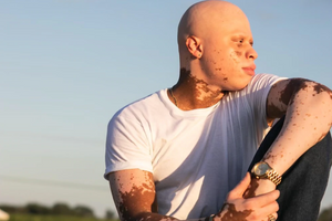 Meet Kirtus Kwincy | Model and D.R.E.S.S. Syndrome Advocate